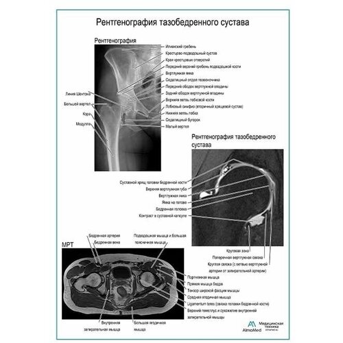 Рентгенография тазобедренного сустава, плакат, глянцевая фотобумага от 200 г/кв. м, размер A2+