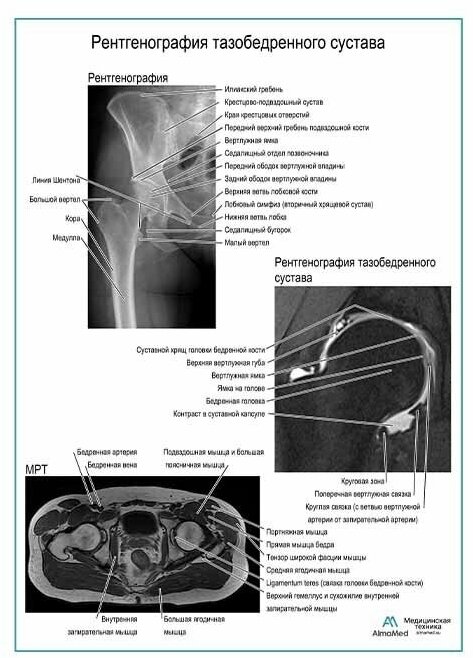 Рентгенография тазобедренного сустава, плакат, глянцевая фотобумага от 200 г/кв. м, размер A2+