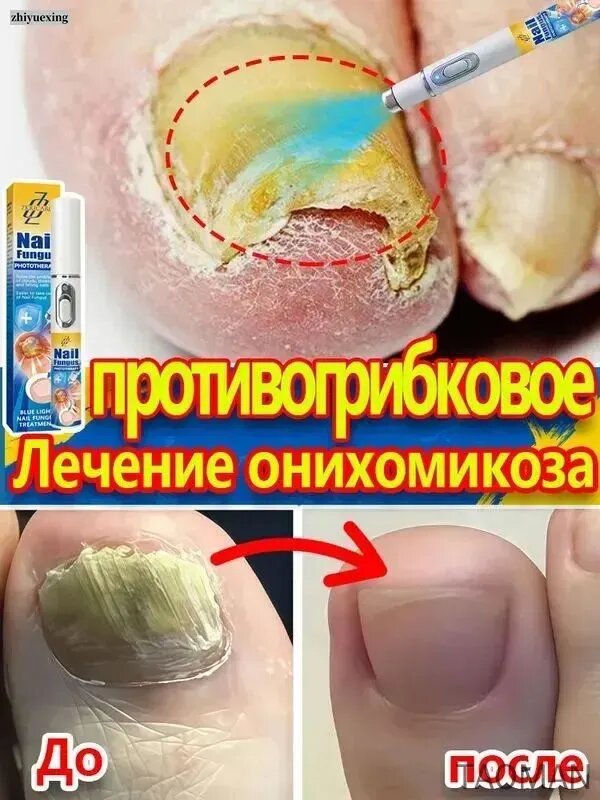 Лазерная указка для лечения грибка ногтей на ногах и руках, для лечения грибка и онихолизиса, для стимуляции роста и укрепления ногтей, для ухода за ногтями и кожей.