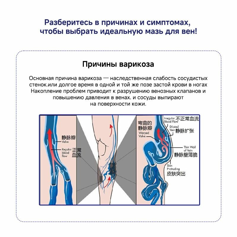 Гомеопатические Препараты От Варикоза Крем от варикоза, для сосудов, отеков и тяжести в ногах, сосудистых звездочек, тромбоза, Эффективен при лечении варикозного расширения вен, 50г