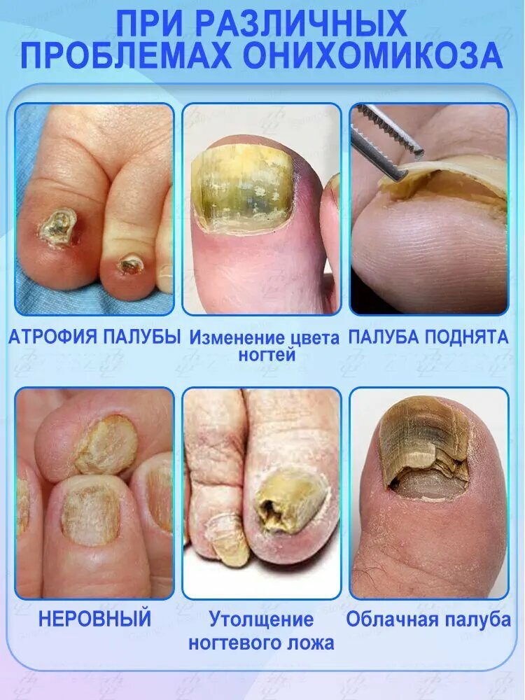 Масло от грибка ногтей для профилактики грибковых инфекций, паронихии, ухода за ногтями и лечения онихомикоза. 10 мл