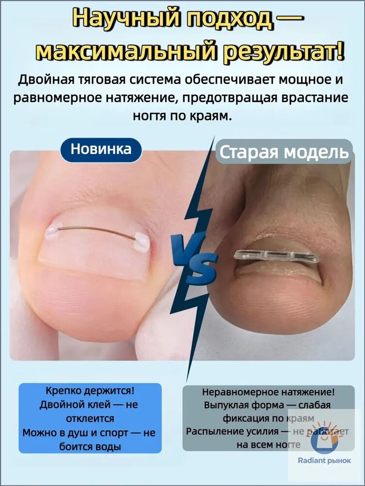 Набор для коррекции вросшего ногтя из никель-титанового сплав
