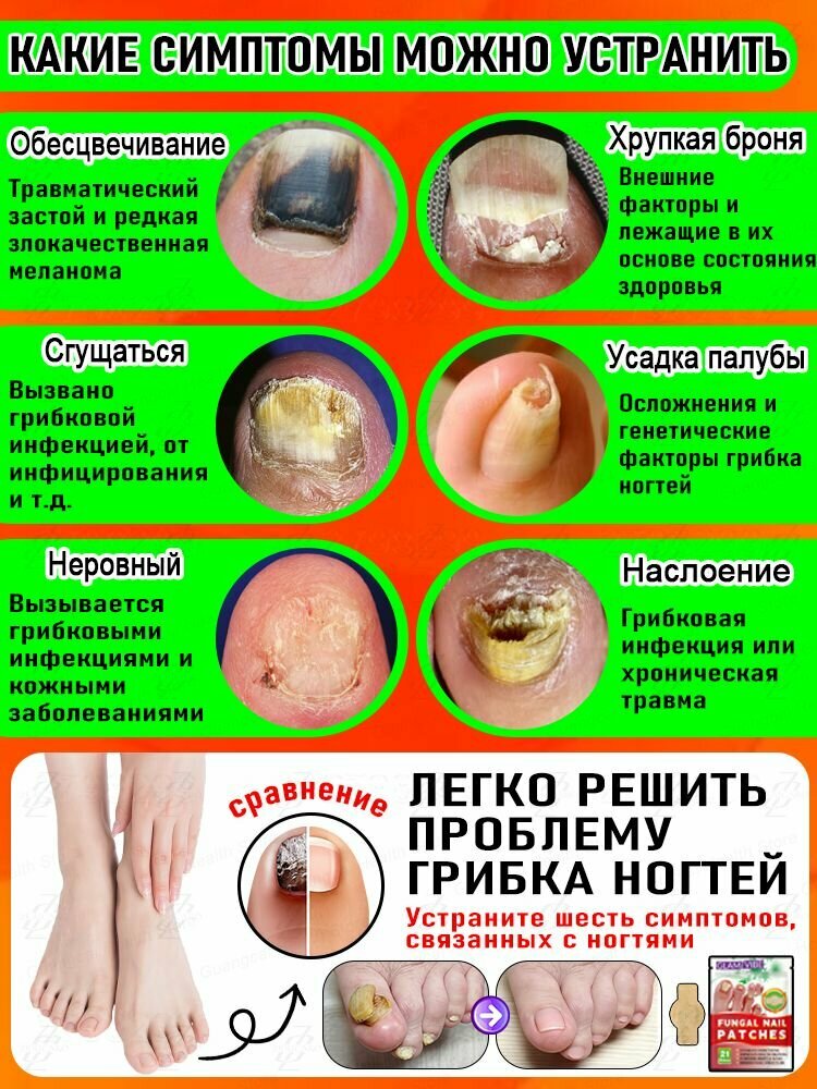 Очаги онихомикоза. 105 очагов.