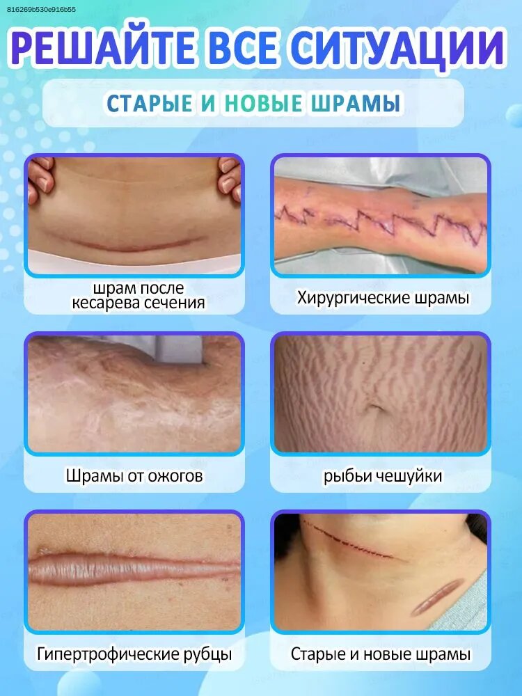 Крем от рубцов, устраняет шрамы, подавляет гиперплазию рубцов, смягчает и успокаивает рубцы, устраняет покраснения и зуд, восстанавливающий барьер, 20 г