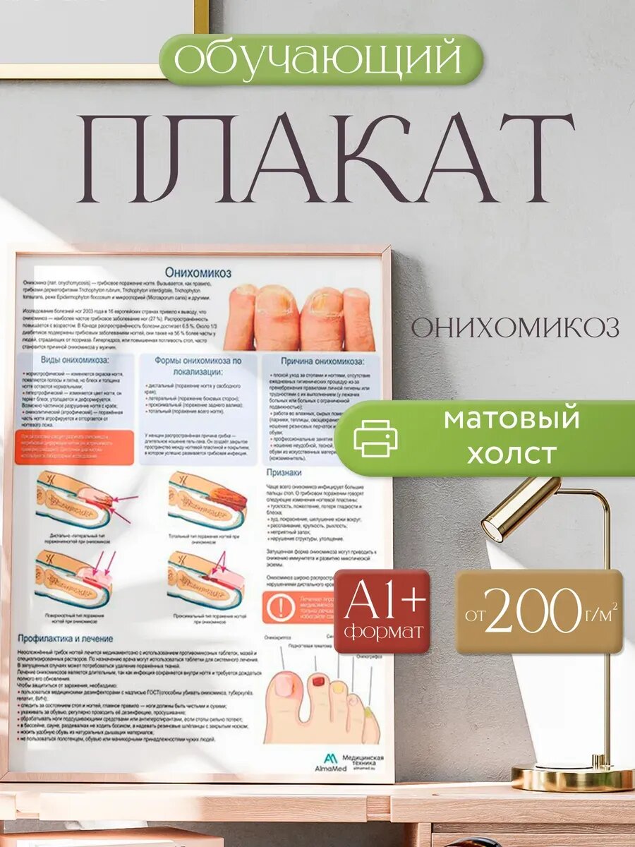 Онихомикоз медицинский плакат А1+/A2+ (матовый холст от 200 г/кв. м, размер A1+ )