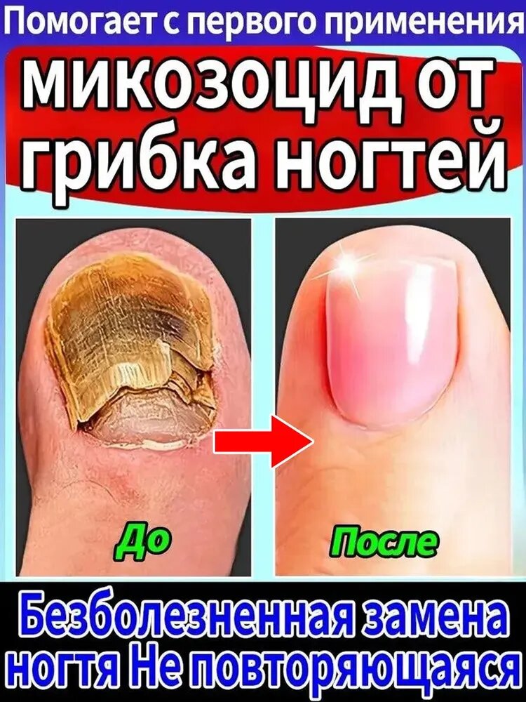 Он подходит для лечения онихомикоза рук и ног, быстрого устранения грибка ногтей, профилактики и лечения онихомикоза и стимуляции роста ногтей. Ингредиенты мягкие и не вызывают раздражения