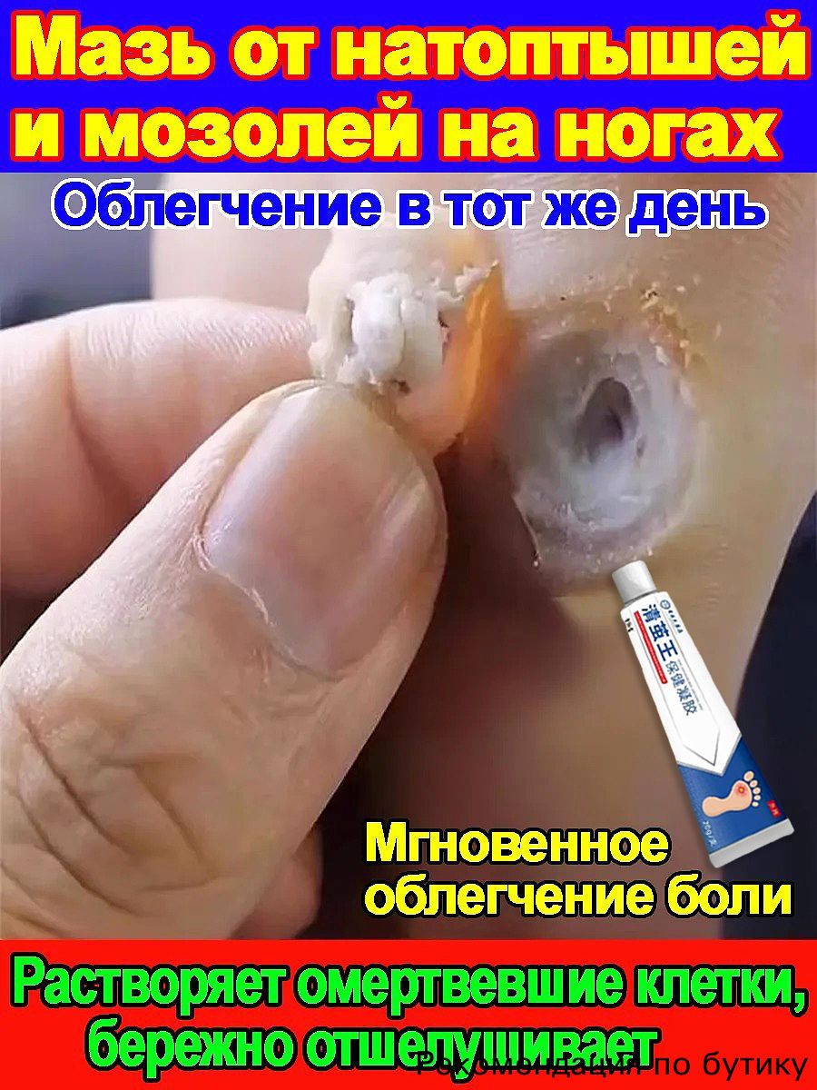 Китайская Чудл Мазь средство от папиллом и бородавок. Эффективный крем для быстрого избавления бородавок, мозольный удаления мозолей, натоптышей 20 г