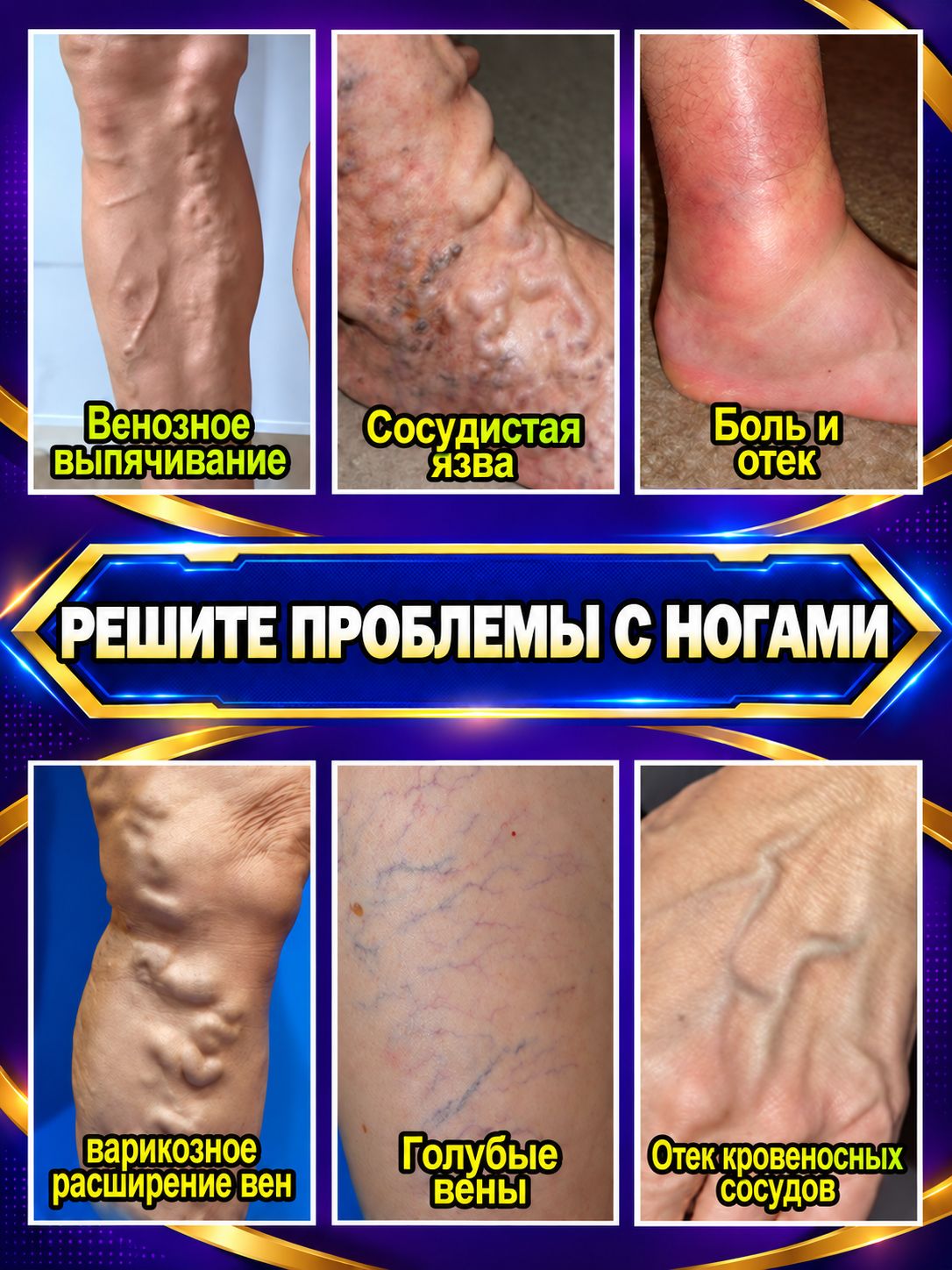 Спрей от варикоза вен на ногах снимает отёки и боль, уменьшает сосудистые звёздочки, улучшает кровообращение, устраняет