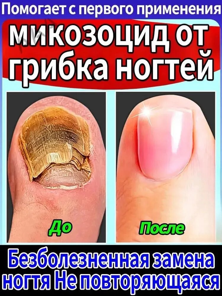 Противогрибковая мазь Ноготок от грибка ногтей на ногах и гиперкератоза, противогрибковое средство для ног,