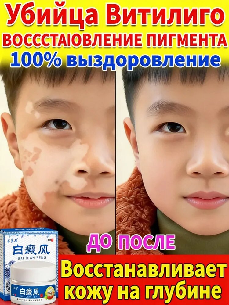 Крем от витилиго, Подходит для пациентов с витилиго, Эффективно удаляет белые пятна, устранения пигментации выравнивания тона кожи. средство для улучшения пигментации и выравнивания тона кожи,30г