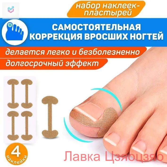 Набор наклеек для коррекции вросших ногтей / Пластырь для исправления пластины при онихокриптозе / Педикюрная корректирующая система для приподнимания ногтя на ноге - 4 шт.