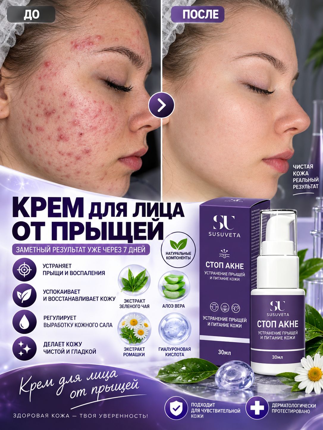 SUSUVETA крем от прыщей с азелаиновой кислотой, для жирной и сухой проблемной кожи лица, постакне, 30 мл