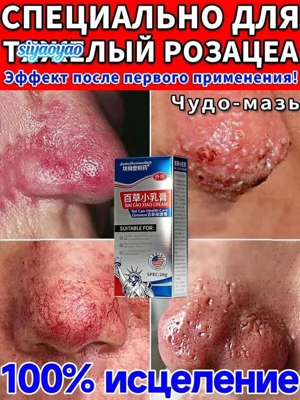 Крем от розацеаисцеление красный нос и прыщи
