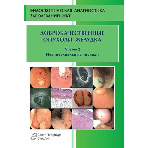 Доброкачественные опухоли желудка. Часть 2 Неэпителиальные опухоли