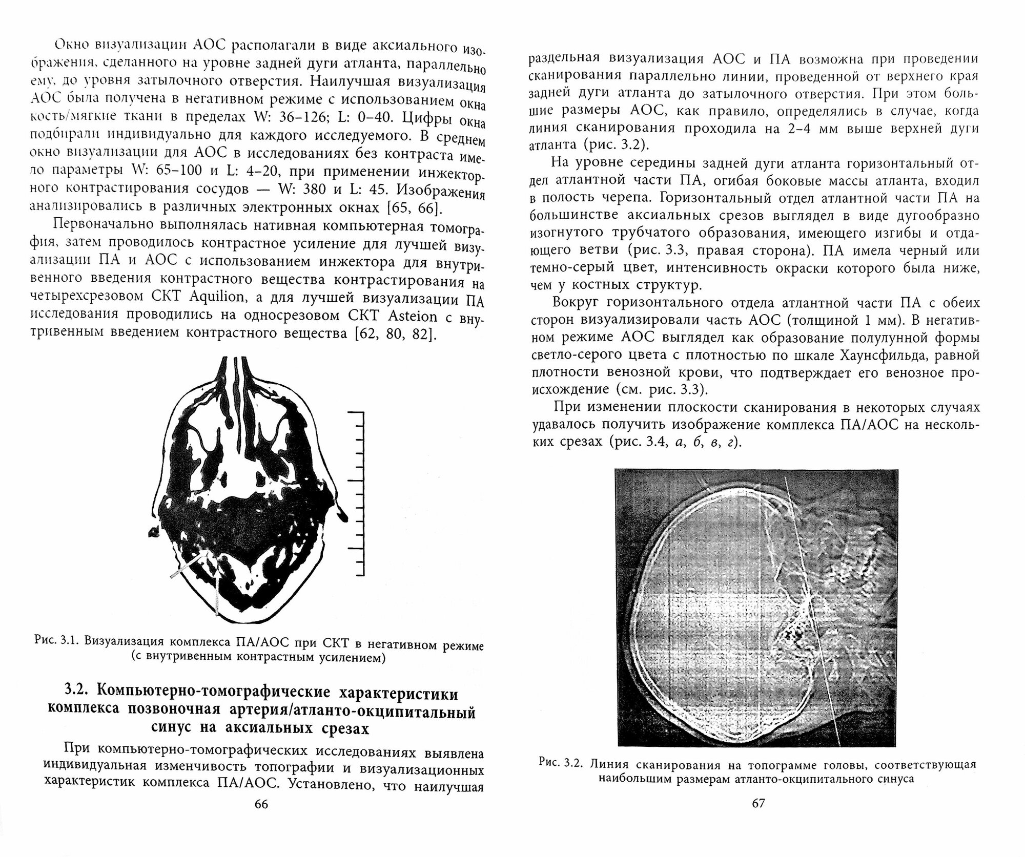 Клиническая анатомия комплекса позвоночная артерия/атланто-окципитальный синус - фото №3