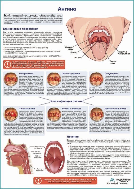 Ангина медицинский плакат, глянцевая фотобумага от 200 г/кв. м, размер A1+