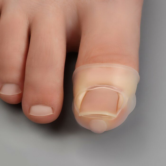 ONLITOP Защитные чехлы для коррекции вросших ногтей, пара, 2,8 х 2 см, цвет прозрачный