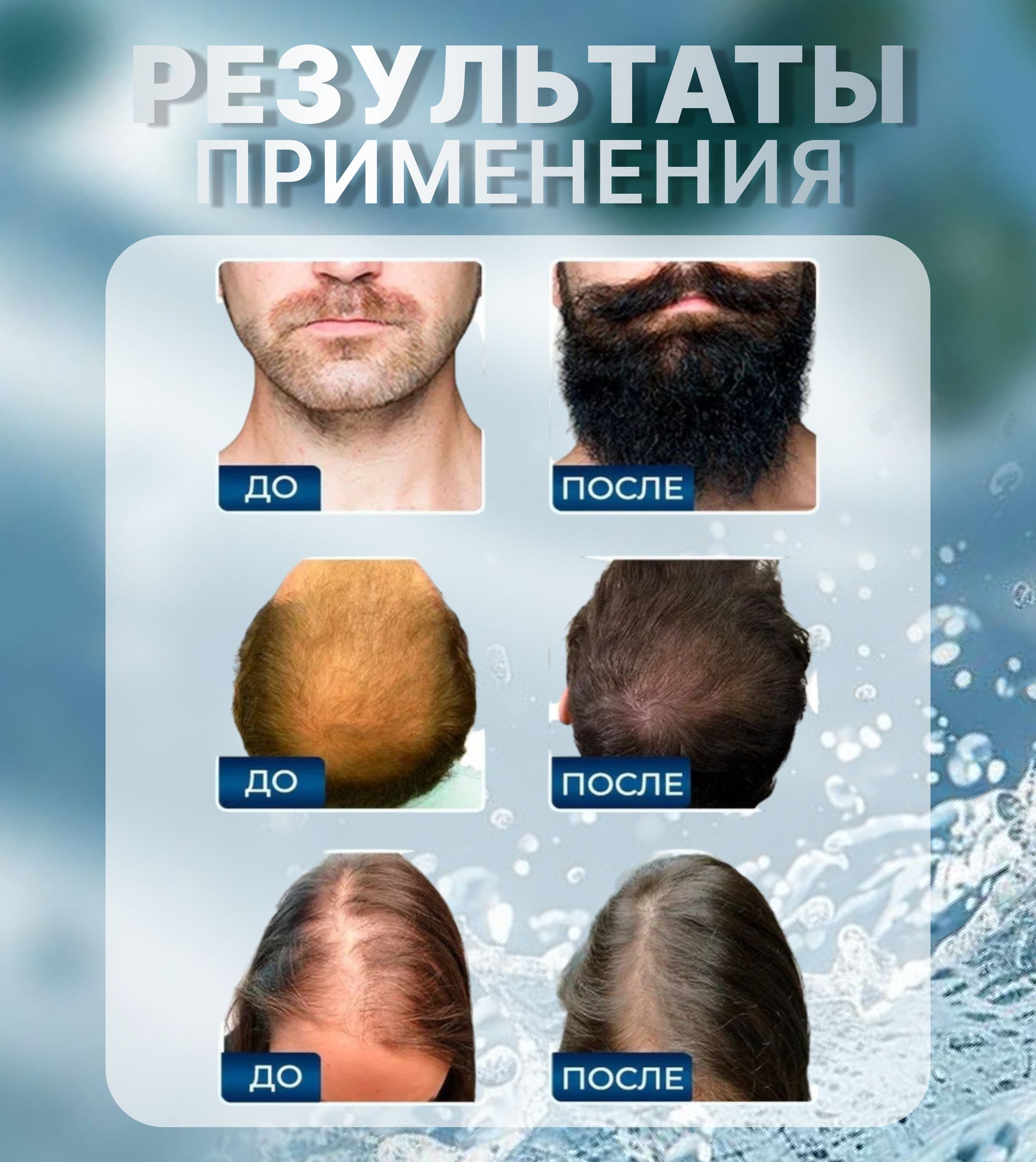 Миноксидин (Minoxidin 5%) для роста волос, для всех типов волос, активация роста, с пипеткой 2 штуки — фото 1