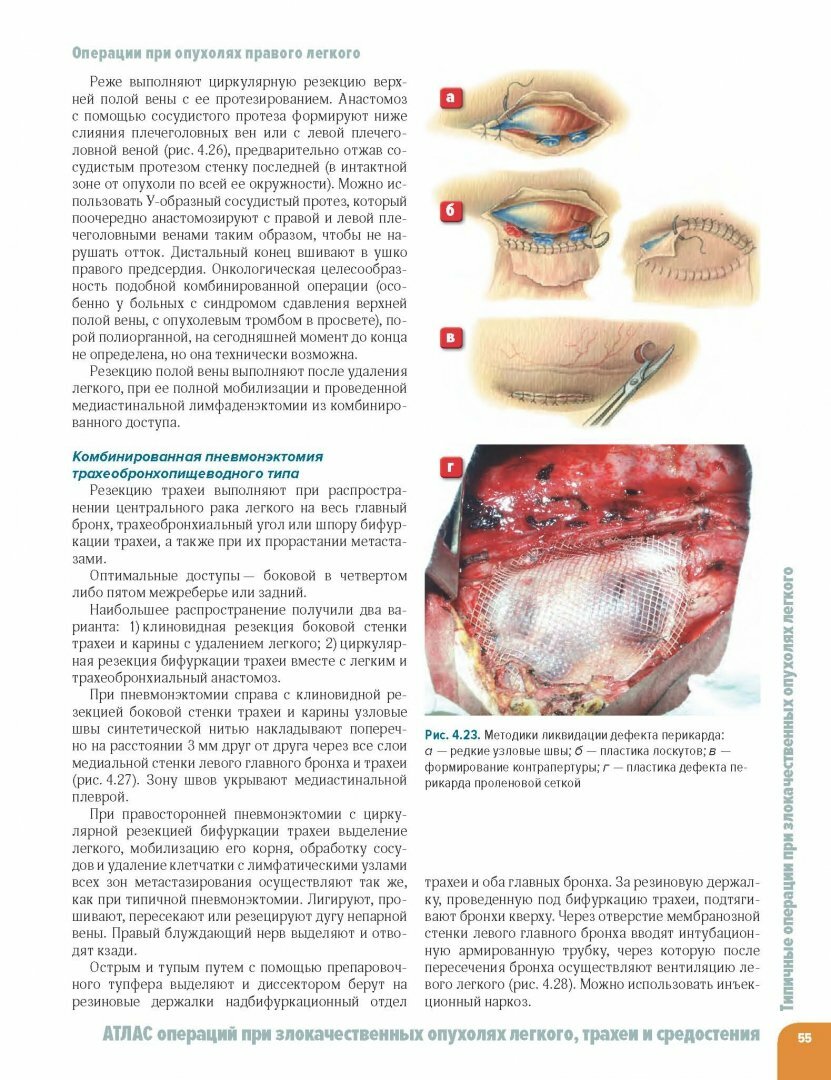 Атлас операций при злокачественных опухолях легкого, трахеи и средостения - фото №3