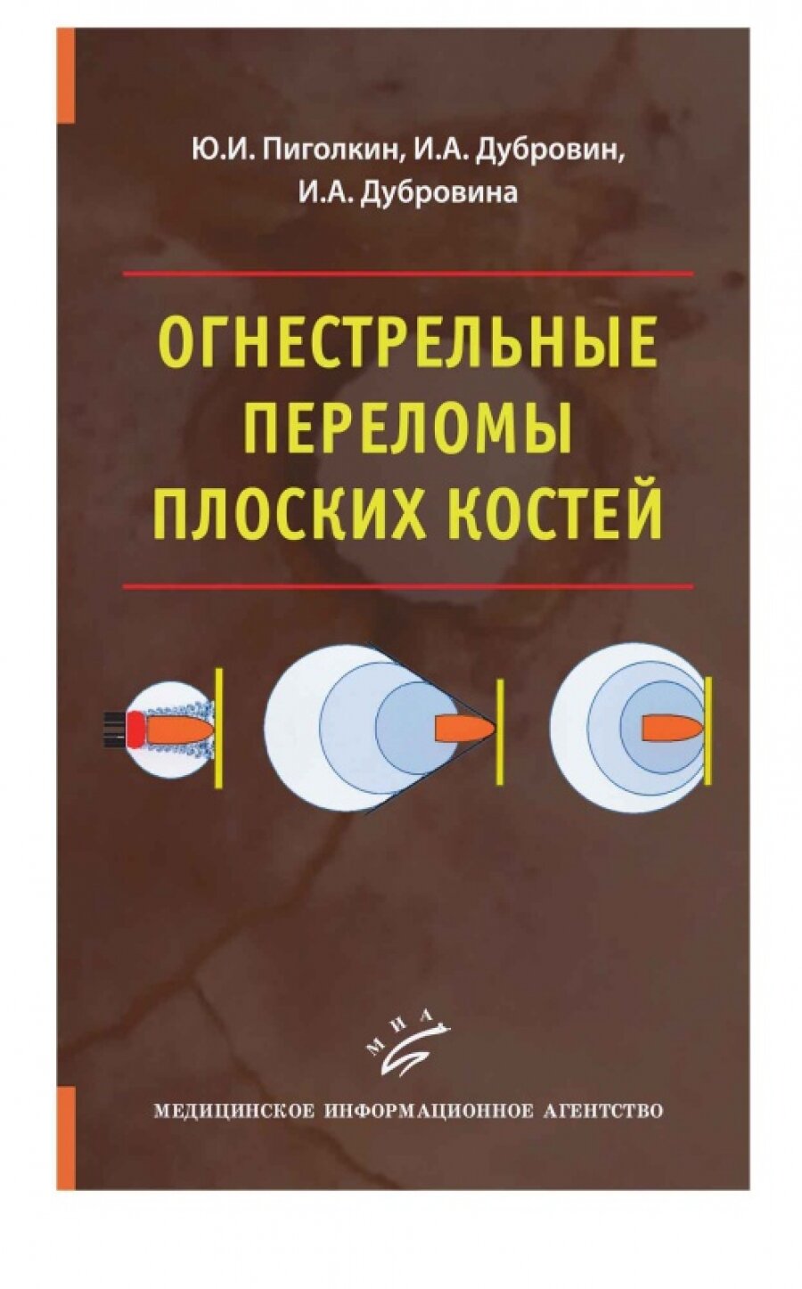 Огнестрельные переломы плоских костей