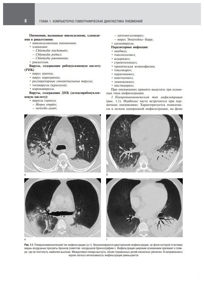 Компьютерная томография в диагностике пневмоний. Атлас - фото №6