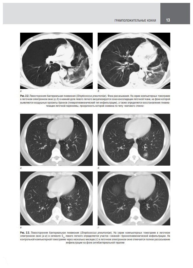 Компьютерная томография в диагностике пневмоний. Атлас - фото №7