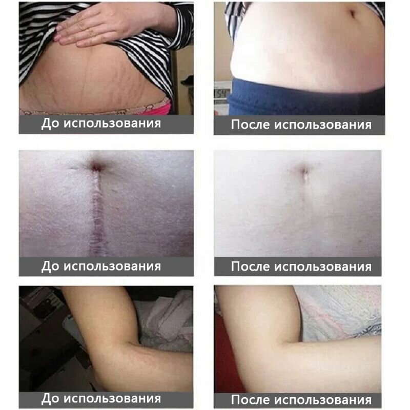 Средство от растяжек