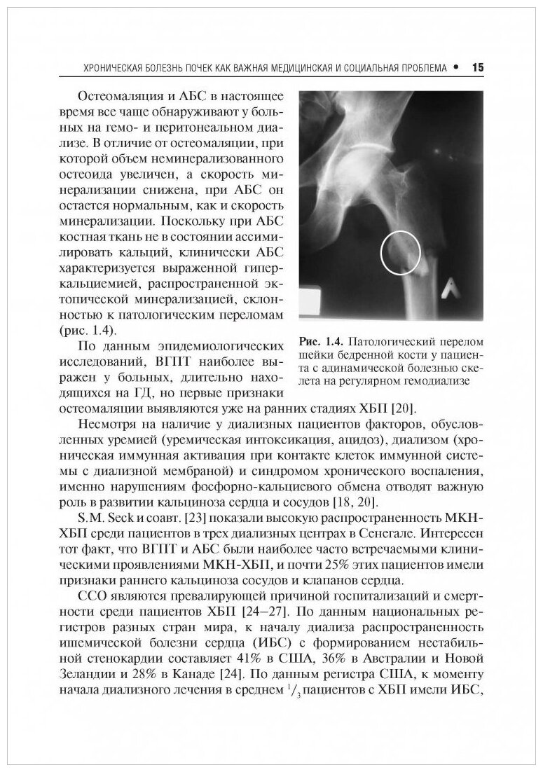 Нарушения минерального и костного обмена при хронической болезни почек - фото №8