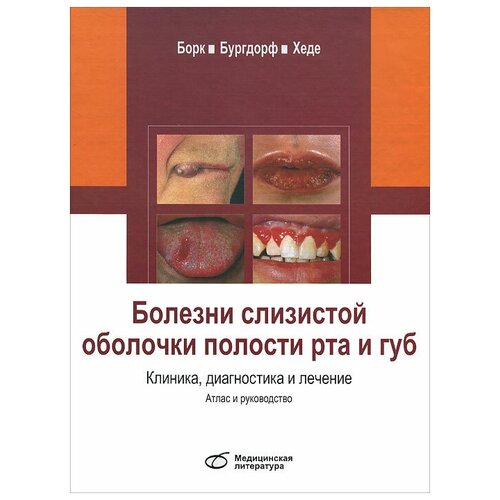 К. Барк, В. Бургорф, Н. Хеде "Болезни слизистой оболочки полости рта и губ. Клиника. Диагностика и лечение. Атлас и руководство"