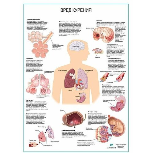 Вред курения, плакат, глянцевая фотобумага от 200 г/кв. м, размер A1+