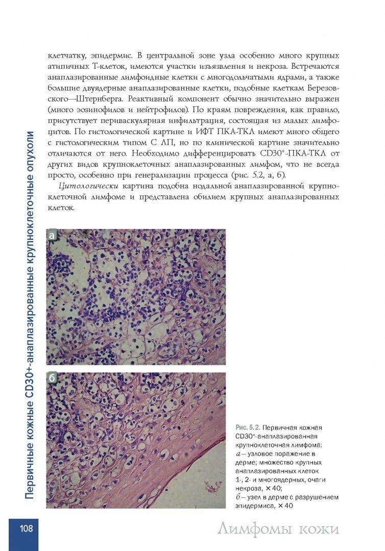 Лимфомы кожи. Диагностика и лечение - фото №12