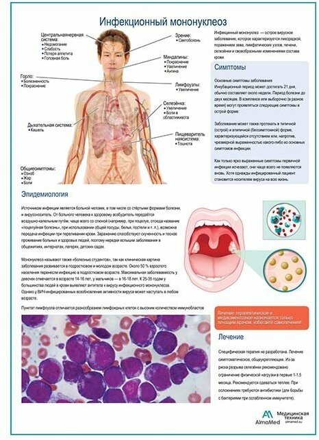 Инфекционный мононуклеоз медицинский плакат глянцевая фотобумага от 200 г/кв. м, размер A1+