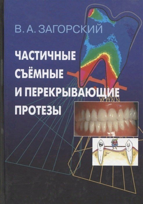 Частичные съемные и перекрывающие протезы