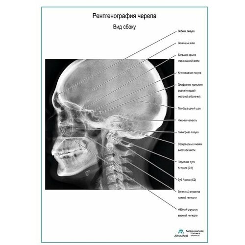 Рентгенография черепа. Вид сбоку плакат, глянцевая фотобумага от 200 г/кв. м, размер A2+