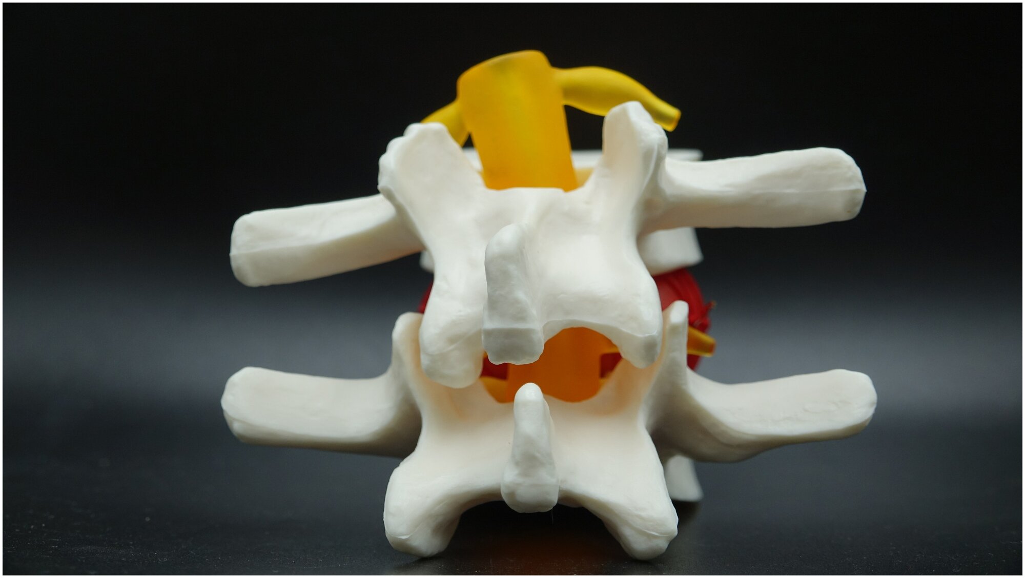 Анатомическая модель позвоночника, грыжа межпозвоночного диска. Масштаб 1: 1,5