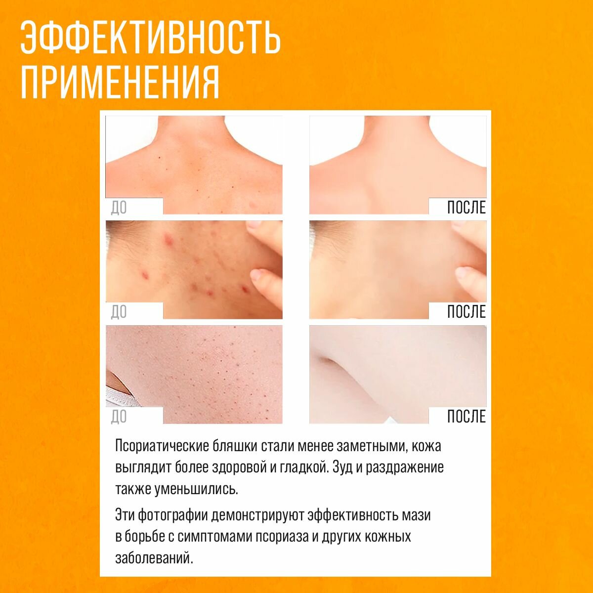 Крем мазь от псориаза для лица и тела Zudaifu Зудайфу 5 штук — фото 1