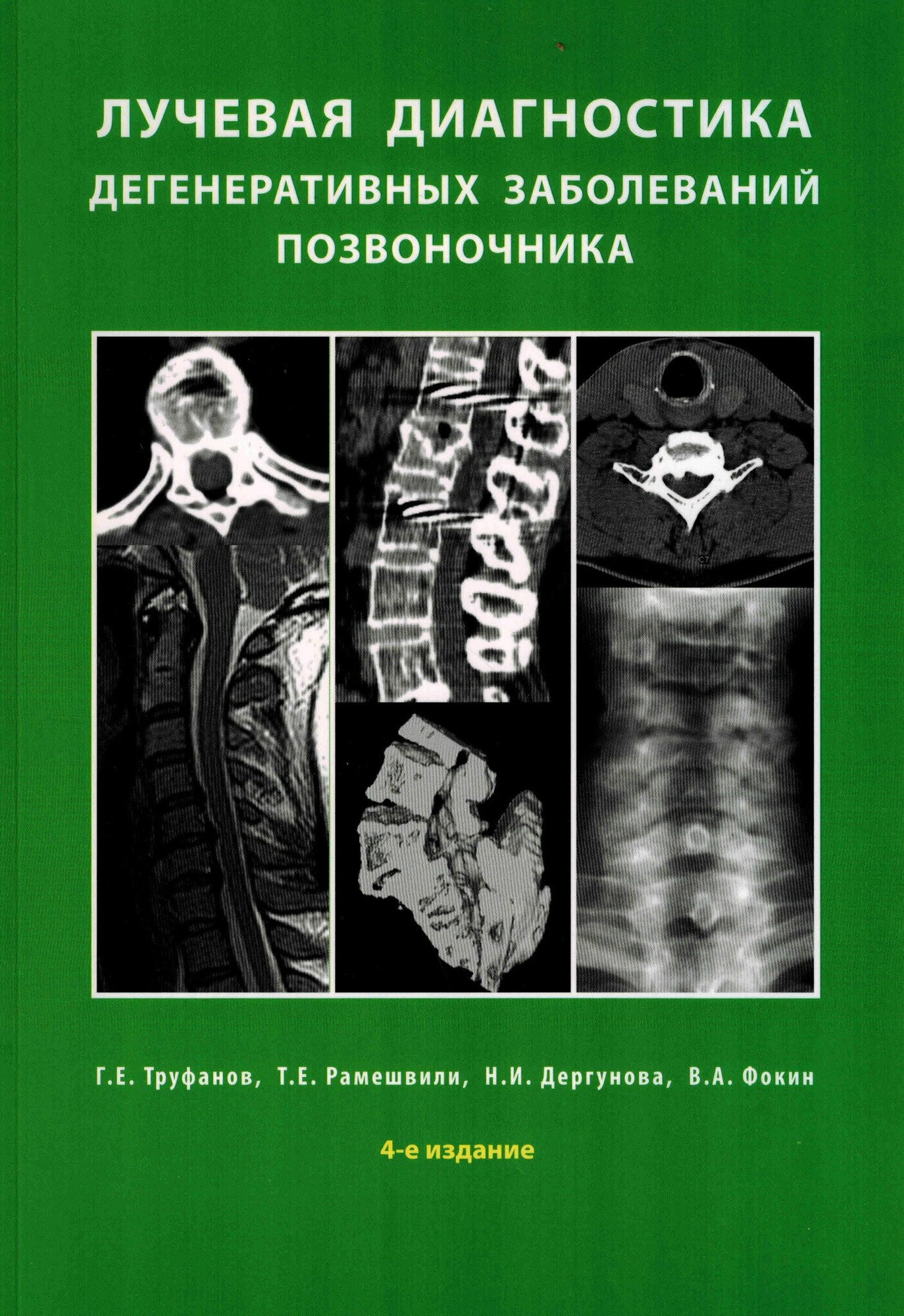 Лучевая диагностика дегенеративных заболеваний позвоночника