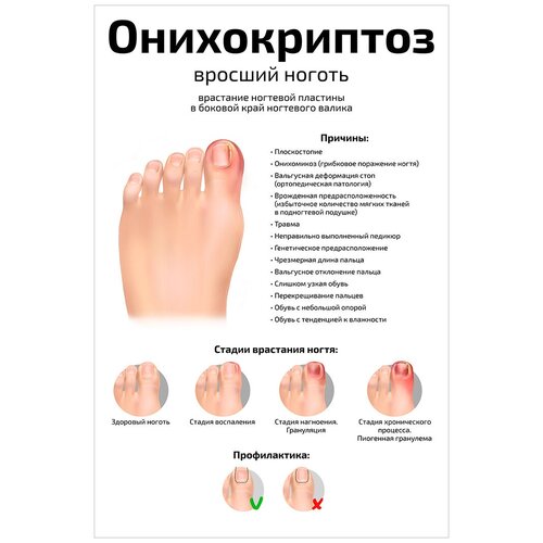 Плакат обучающий А2 ламинир. Онихокриптоз вросший ноготь косметологический Плакат обучающий 457x610 мм