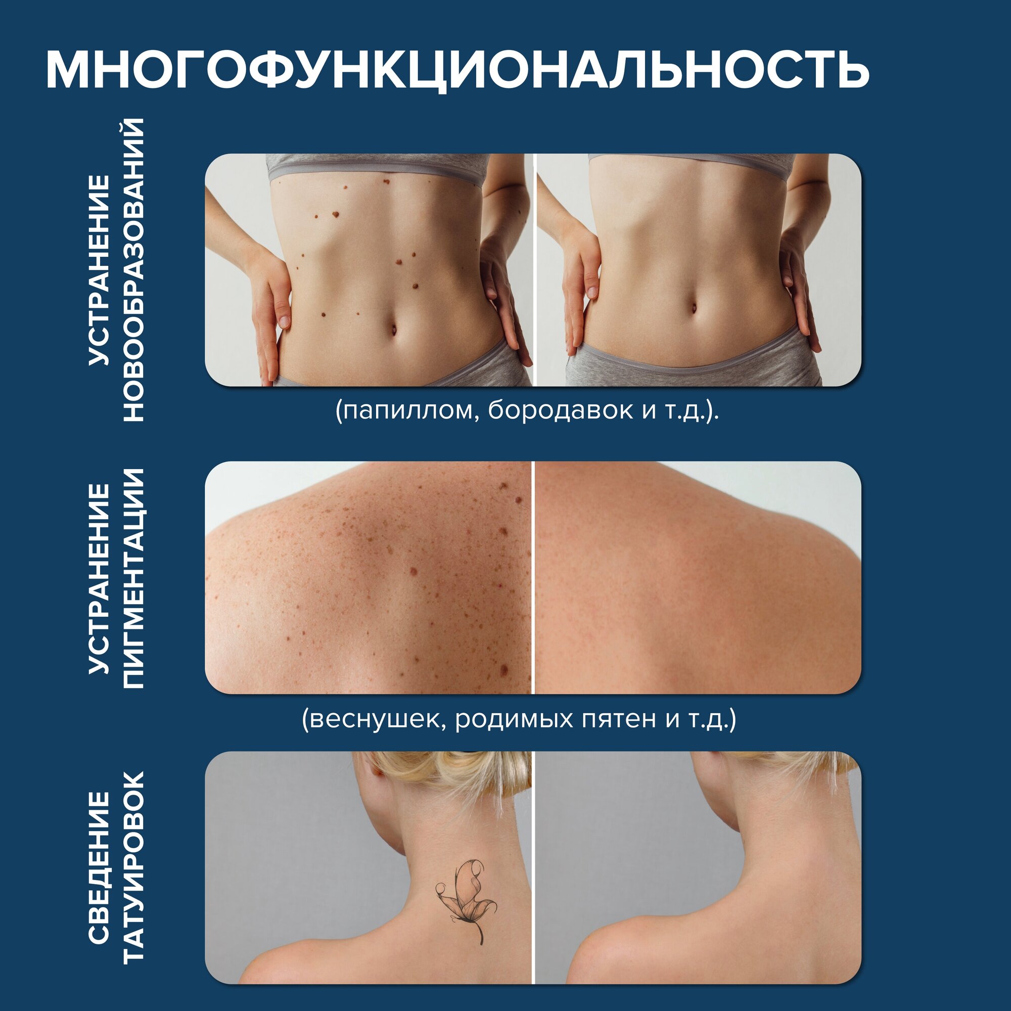 Косметологическое оборудование для удаления пигментации и родинок. Время работы 80 мин. Аппарат для удаления родинок, папиллом, татуировок