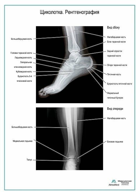 Щиколотка. Рентгенография