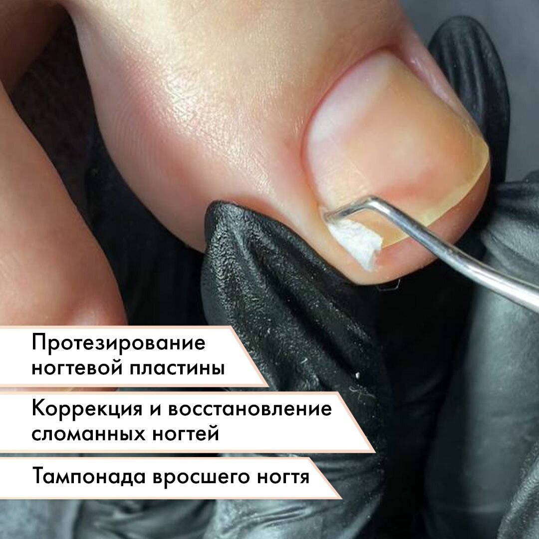 Кополин для вросшего ногтя 4 м х 1,4 см плотный ParisNail — фото 1