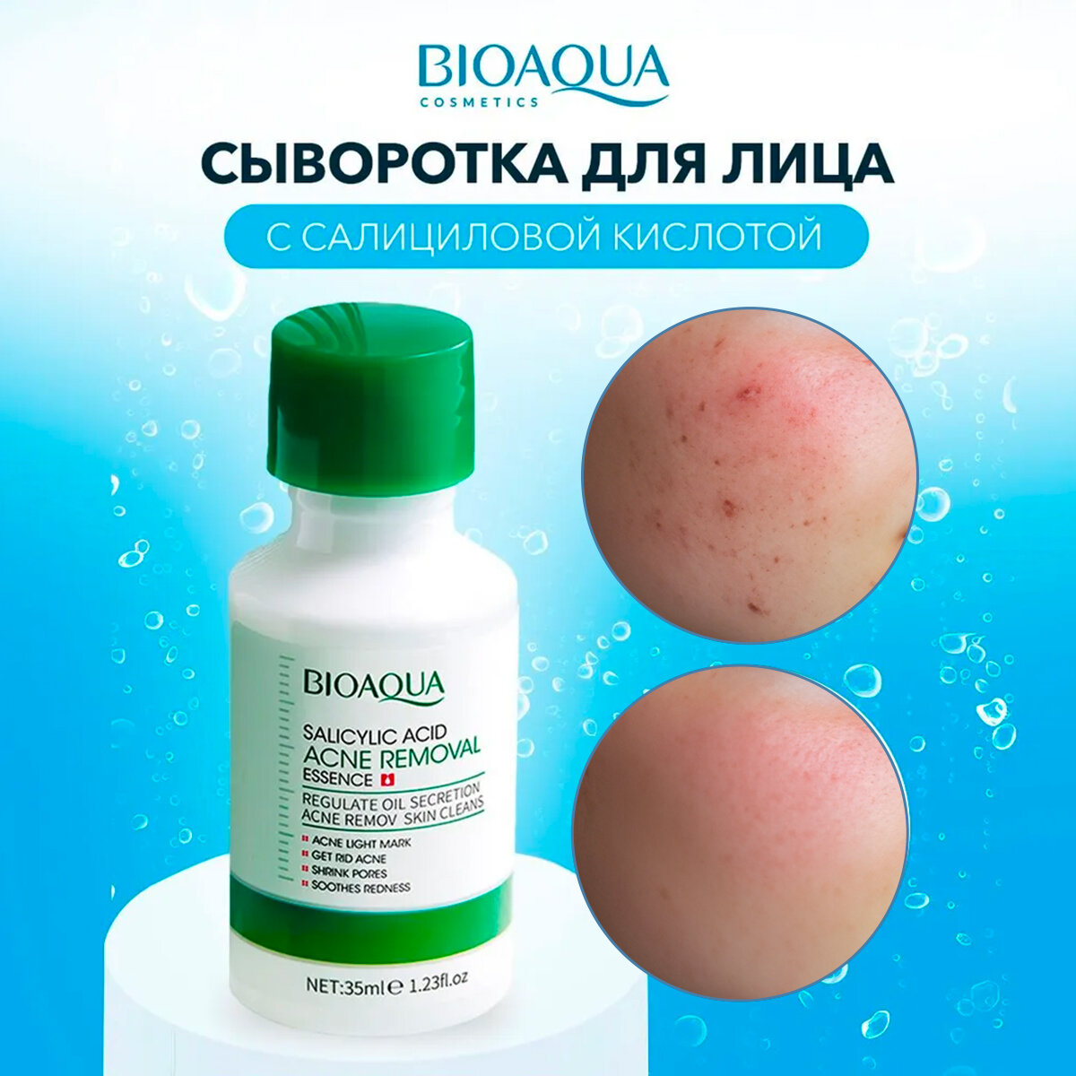 Bioaqua Сыворотка для лица от прыщей увлажняющая с салициловой кислотой