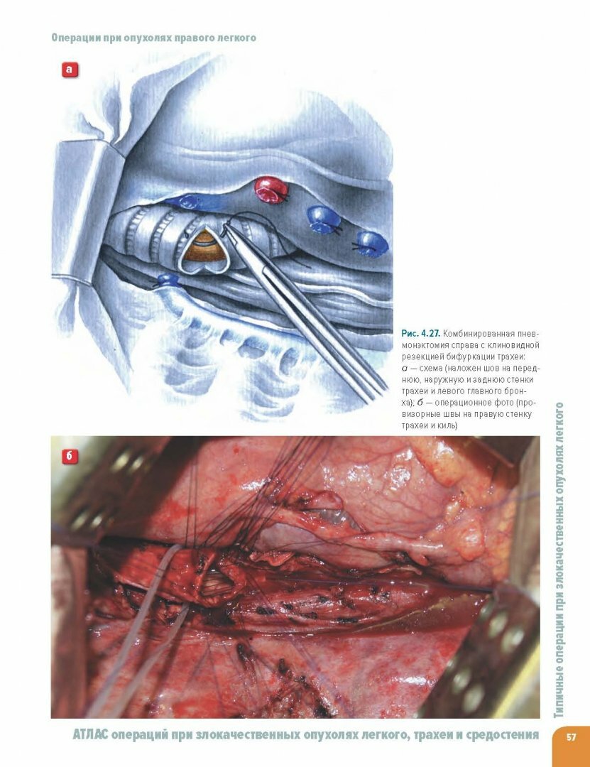 Атлас операций при злокачественных опухолях легкого, трахеи и средостения - фото №4