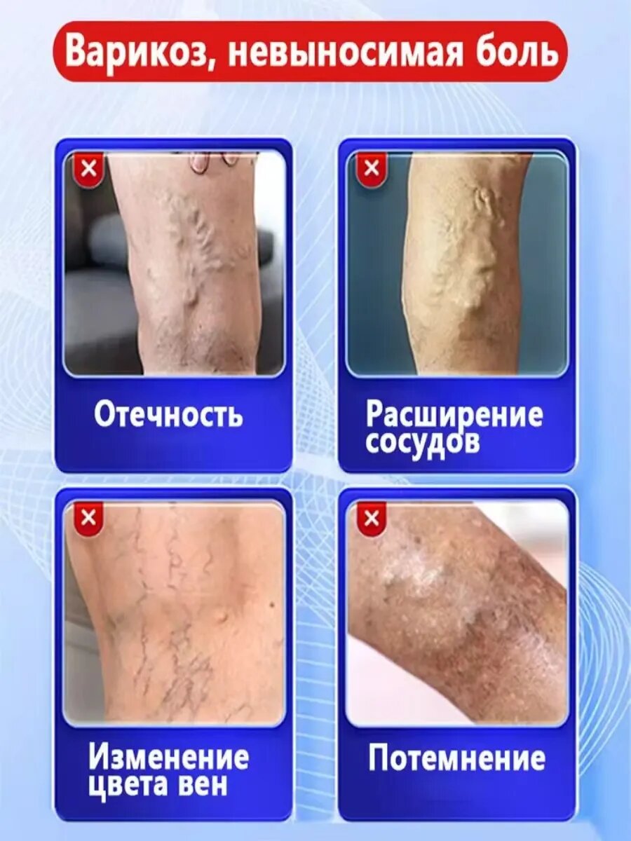 Картинки Мазь от варикоза вен на ногах 50g