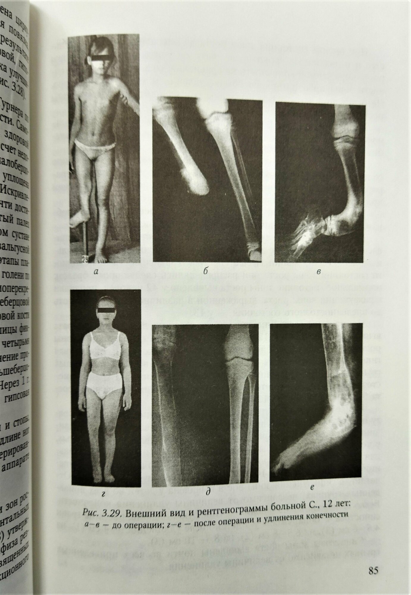 Врожденные пороки развития костей голени у детей. Монография - фото №4