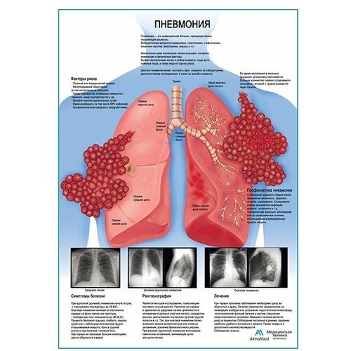 Пневмония, плакат, глянцевая фотобумага от 200 г/кв. м, размер A1+