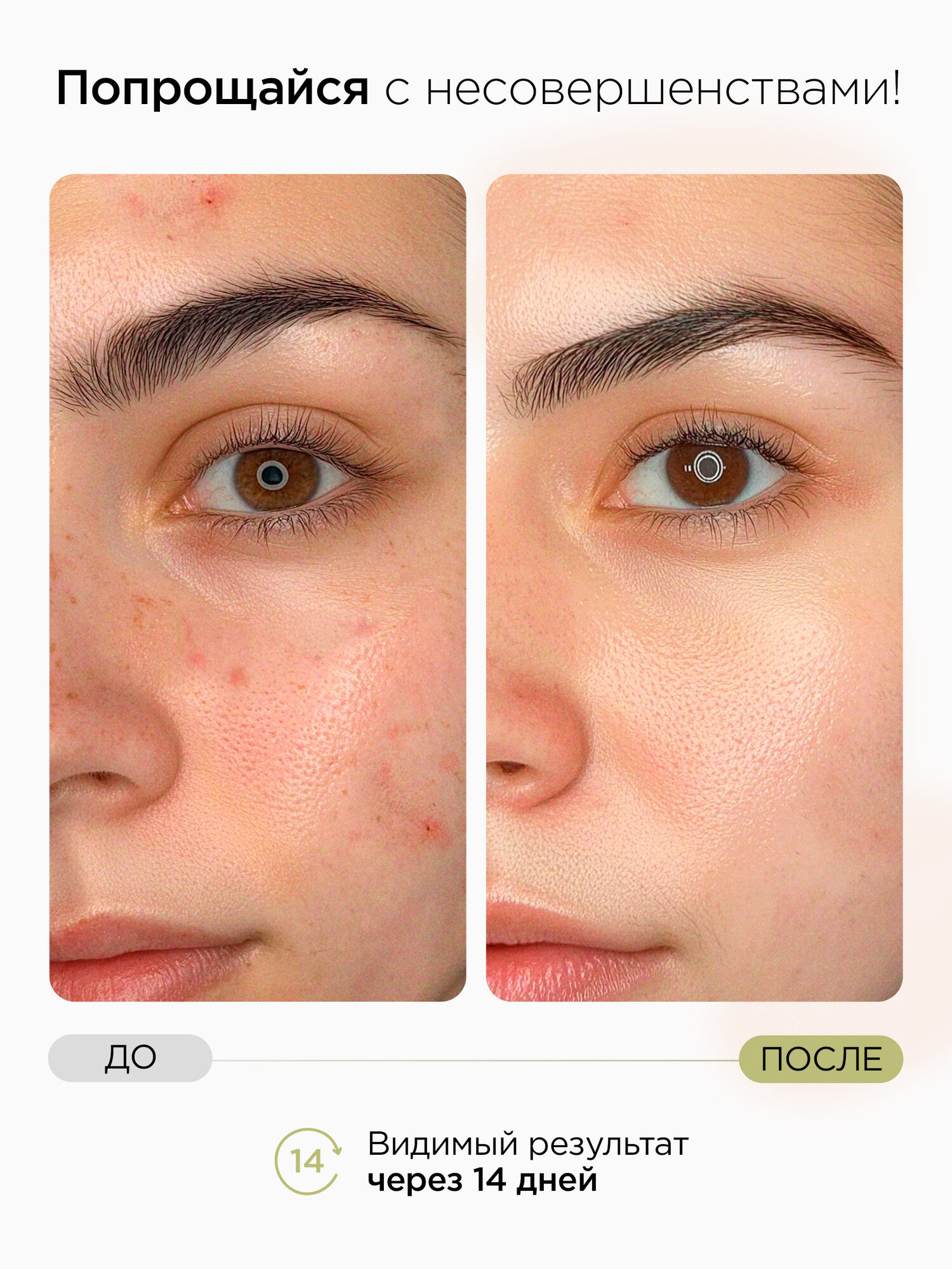 MIXIT Очищающие пилинг-диски "Stop Acne Face Pads", для проблемной кожи, 250мл — фото 1