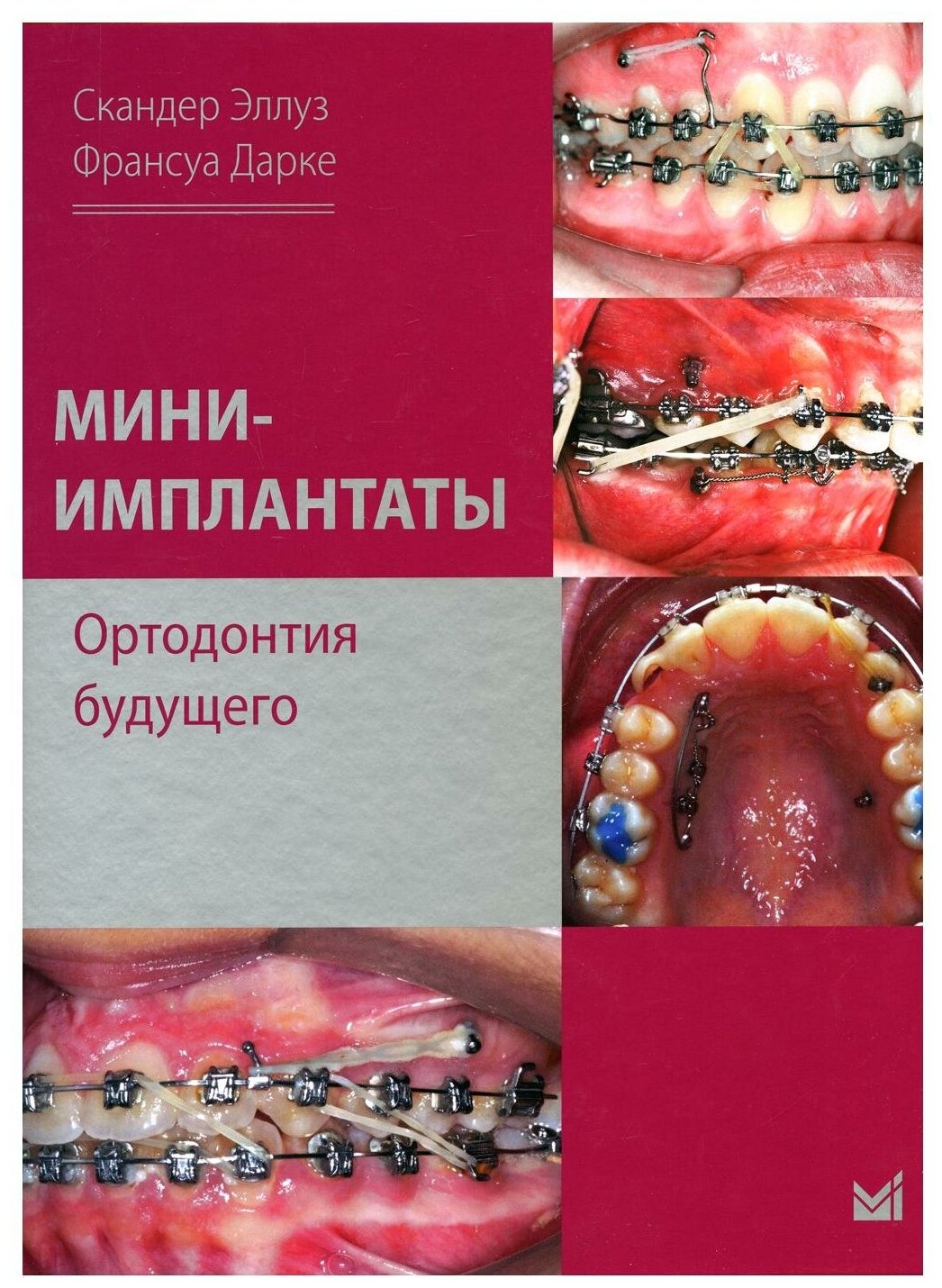 Мини-имплантаты Ортодонтия будущего - фото №1