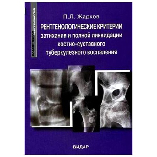 Рентгенологические критерии затихания и полной ликвидации костно-суставного туберкулезного воспаления