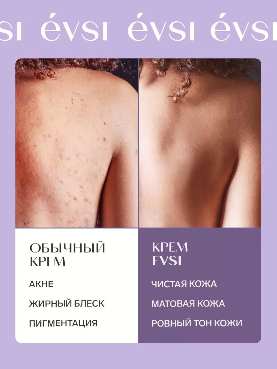 Картинки Мультикислотный крем EVSI, для лица и тела, от прыщей, 150мл